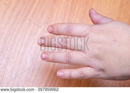 Close-up Of Female Hand With Natural Raw Dirty Nails On Wooden Background. Peeling On Nails. Nail An