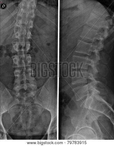 lumbar spine x-ray