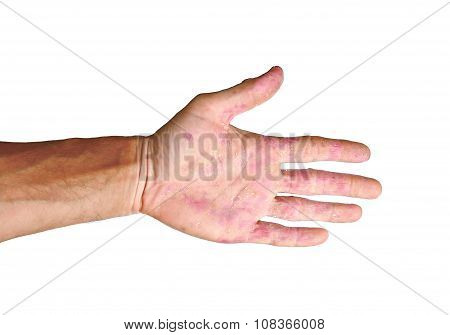 Palm Patient Erythema In Red Spots From Inflammation Isolated