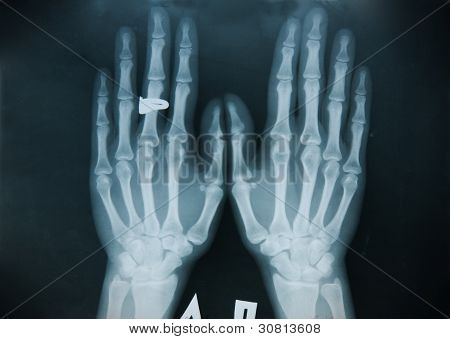 Röntgen Hand (Finger)