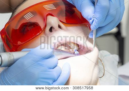 Girl Patient At The Reception At The Dentist. Treatment Of Carious Tooth. The Girl Lies On The Denta