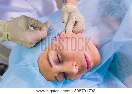 Aged Woman Doing Mesothreads And Thread Lifting, Cosmetology. Cosmetic Procedure To Eliminate Signs 