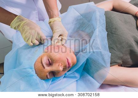Aged Woman Doing Mesothreads And Thread Lifting, Cosmetology. Cosmetic Procedure To Eliminate Signs 