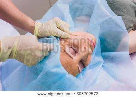 Aged Woman Doing Mesothreads And Thread Lifting, Cosmetology. Cosmetic Procedure To Eliminate Signs 