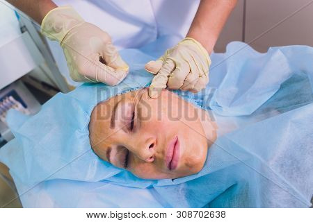 Aged Woman Doing Mesothreads And Thread Lifting, Cosmetology. Cosmetic Procedure To Eliminate Signs 