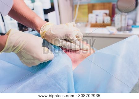 Aged Woman Doing Mesothreads And Thread Lifting, Cosmetology. Cosmetic Procedure To Eliminate Signs 