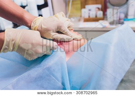 Aged Woman Doing Mesothreads And Thread Lifting, Cosmetology. Cosmetic Procedure To Eliminate Signs 