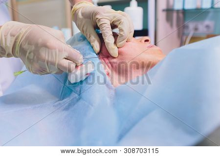 Aged Woman Doing Mesothreads And Thread Lifting, Cosmetology. Cosmetic Procedure To Eliminate Signs 