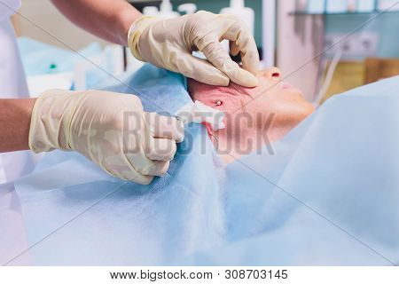 Aged Woman Doing Mesothreads And Thread Lifting, Cosmetology. Cosmetic Procedure To Eliminate Signs 