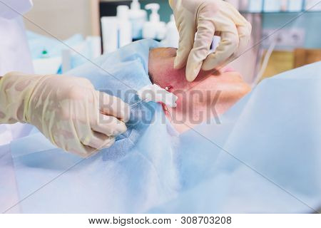 Aged Woman Doing Mesothreads And Thread Lifting, Cosmetology. Cosmetic Procedure To Eliminate Signs 
