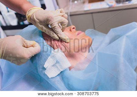 Aged Woman Doing Mesothreads And Thread Lifting, Cosmetology. Cosmetic Procedure To Eliminate Signs 