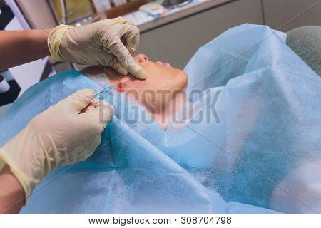 Aged Woman Doing Mesothreads And Thread Lifting, Cosmetology. Cosmetic Procedure To Eliminate Signs 