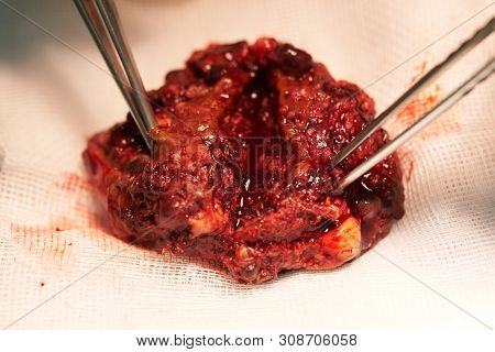 Close-up View Of Abnormal Vascular In The Brain Causing Seizure. Specimen Was Cut In Half And Holdin