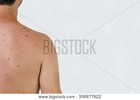 A Male Shoulder With Sunspots, Skin, Back, Melanoma