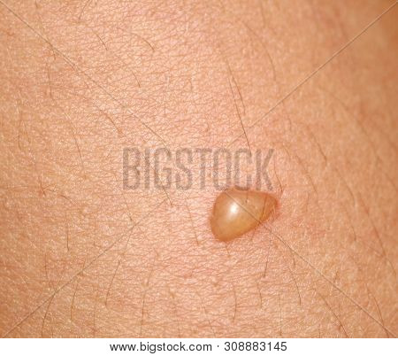 Bubble On The Skin. Blister On The Skin.