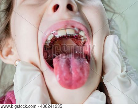 A Child At The Doctor. The Doctor Examines The Throat Of A Child.