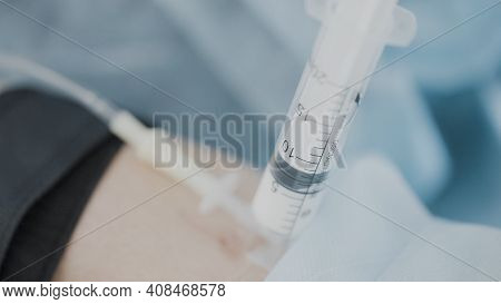 Close-up Shot Of Anesthesia. Action. Injection Of Anesthesia Is Injected Into Patients Arm Before Op