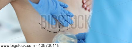 Plastic Surgeons Hands Are Holding Breast Implant In Front Of Nude Patient With Lines Drawn With Mar