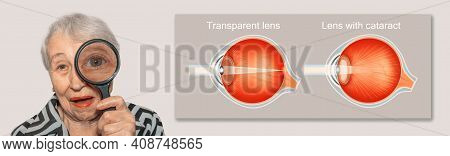 Cataract Concept. Senior Woman's Eye, Closeup And Cataracts And Healthy Eye Detailed Structure. Coll