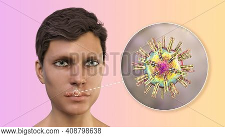Herpes Labialis, Also Known As Cold Sores, 3d Illustration Showing Lesions On The Man's Lips Caused 
