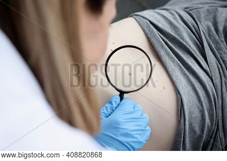 Doctor Oncologist Examining Pigmented Nevus Using Magnifying Glass Closeup. Diagnosis Of Skin Tumors