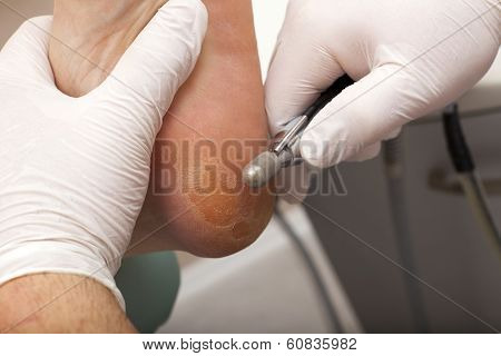 Remove Skin With A Grinder