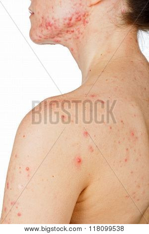 Young Girl With Skin Problem