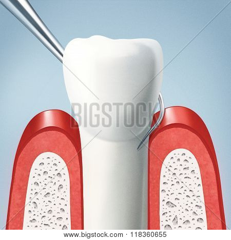 Removal of subgingival deposits around the teeth in dentistry