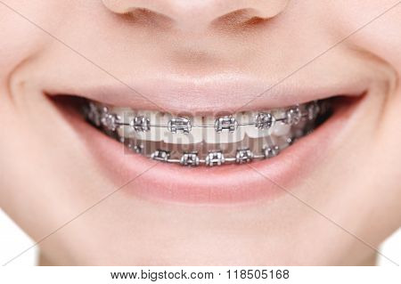 Broad smile girl with metal braces. Closeup