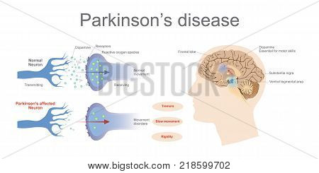 Dopamine levels in a normal and a Parkinson's Affected neurone. Graphic Art Illustration.