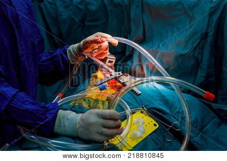 Surgeons perform the operation. Closeup of doctor's hand in gloves during the operation. Healthcare and medical concept. Aseptic surgical instruments close-up lie on the table.