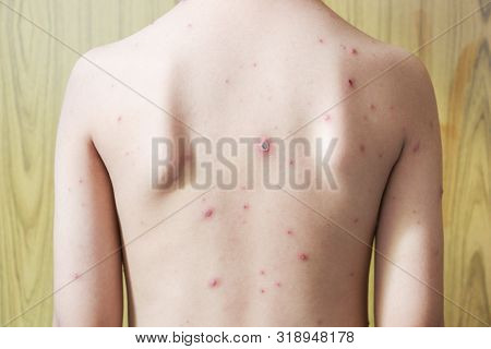 Chicken Pox Rash On Young Boy Body.chickenpox Is An Infection Caused By The Varicella Zoster Virus. 