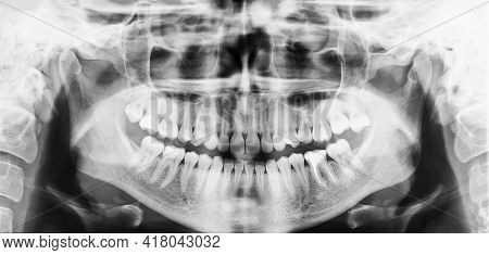 Panoramic Dental X-ray Of The Oral Cavity With Teeth