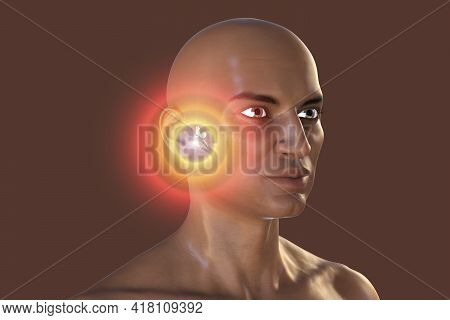Otitis Media In An African Man, A Group Of Inflammatory Diseases Of The Middle Ear, 3d Illustration