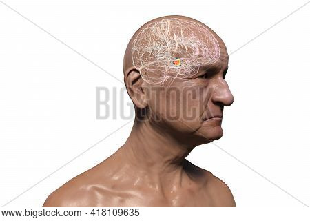 An Old Man With Highlighted Brain And Black Substance Of The Midbrain, 3d Illustration. Black Substa