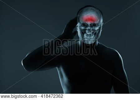 X-ray Of A Man's Head. Medical Examination Of Head Injuries. Cerebral Stroke. Frontal Part Of The Br