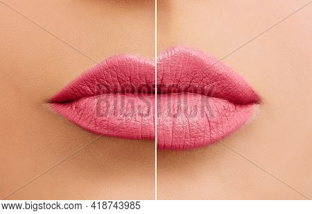 Beautiful Woman Lips Before And After Lip Filler Injections Close Up