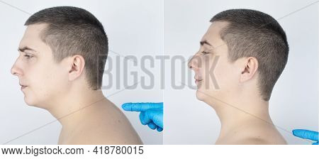 Before And After Kyphosis. The Man Suffers From A Curvature Of The Spine In The Upper Section. The C
