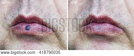 Image Before And After Removal Of Venous Lake On Lip Of Mouth.