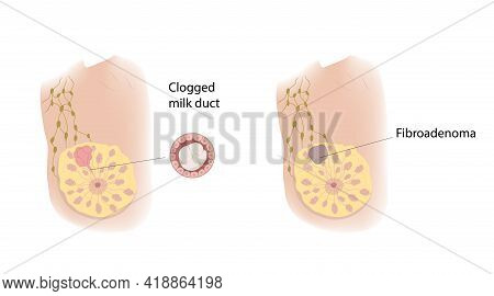 Woman Breast. Clogged Milk Duct And Fibroadenoma. Comparison. Medical Vector Illustration.