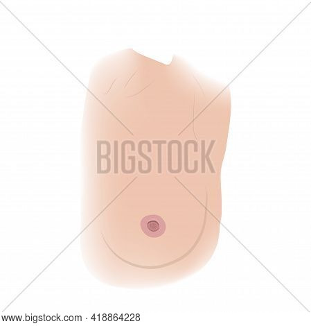 Woman Breast. Cancer Symptoms. Nipple Inversion. Medical Vector Illustration.