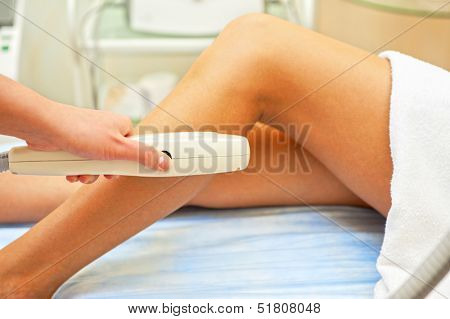 Laser hair removal