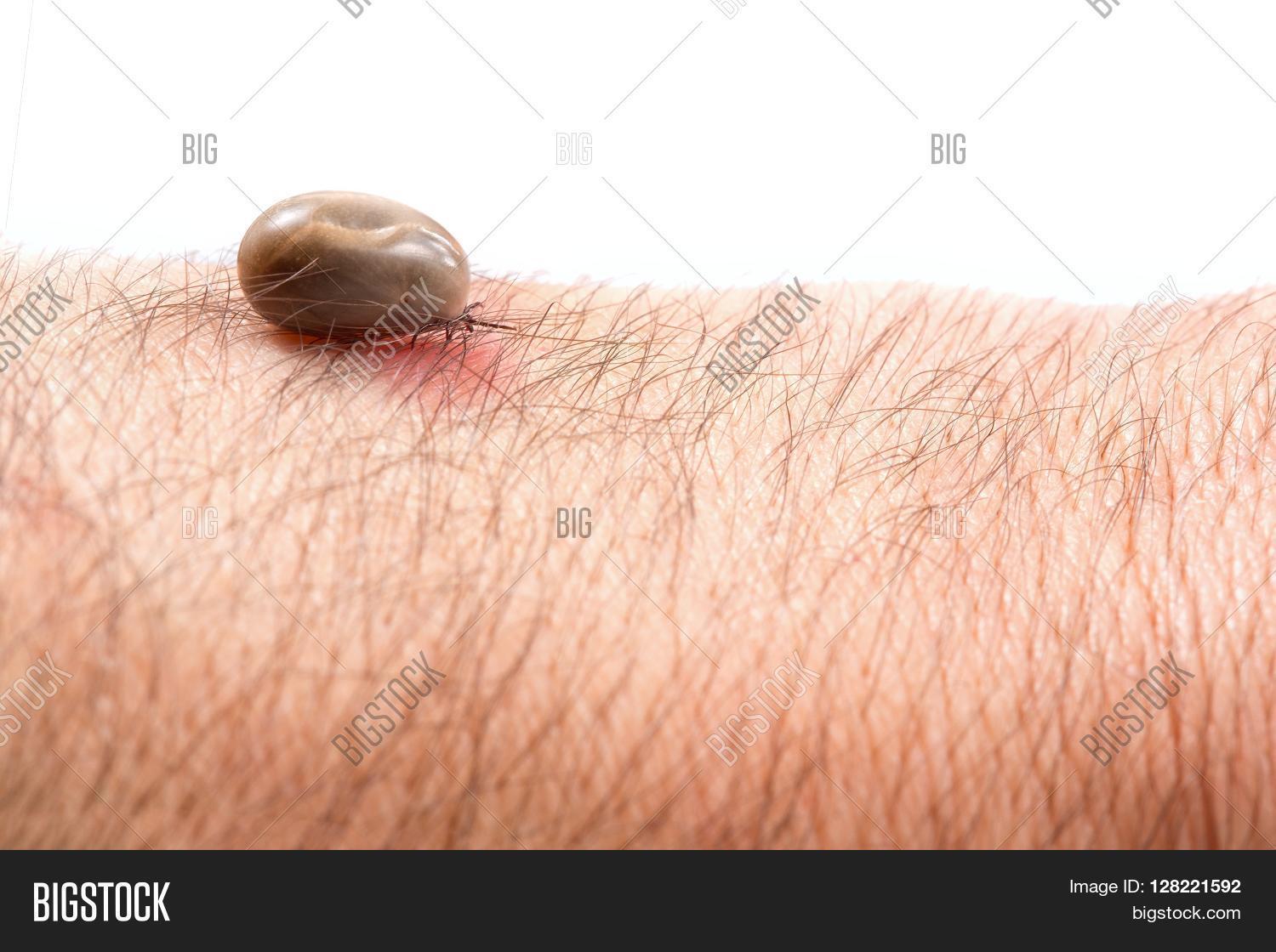 human skin stock photo 169 chaoss 1695911 tick on human skin spots image photo bigstock human skin stock photo 169 chaoss 1695911 tick on human skin spots image photo bigstock