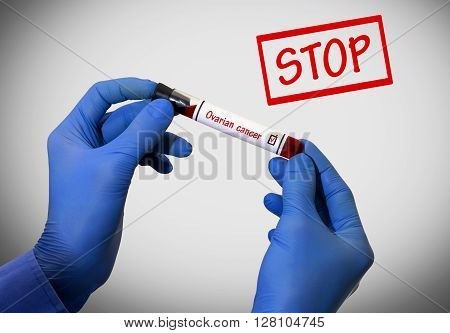 Stop ovarian cancer. Positive result of blood test. Test tube with a blood test in the doctor's hands. Medical concept.