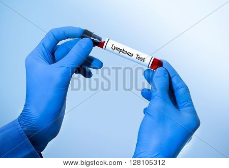 Positive result of blood test for lymphoma. Test tube with a blood test in the doctor's hands. Medical concept.