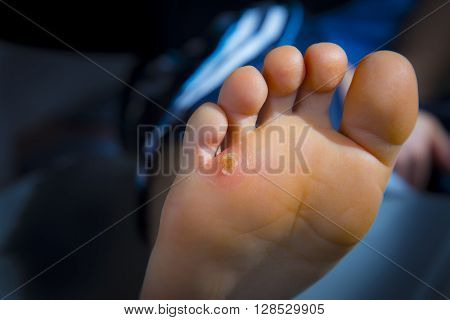 Calluses On Foot