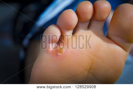Calluses On Foot