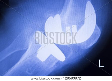 Knee Injury Surgical Implant Xray Scan