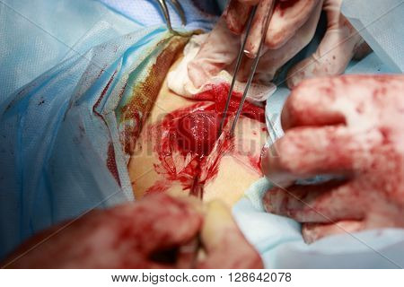 surgery close-up of stoma making with a gut surgeon's hands and surgical tools