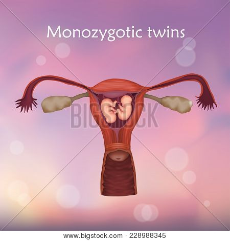 Multiple Pregnancy. Monozygotic Twins, Embryo, Fetus In Uterus, Placenta, Umbilical Cord. Vector Med